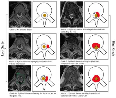 Frontiers Deep Learning Model For Classifying Metastatic Epidural Spinal Cord Compression On MRI